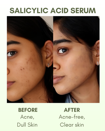 Zero The Start 2% Salicylic Acid Serum