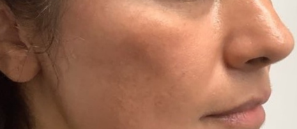 image comparison after