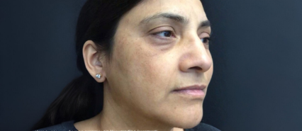 image comparison after